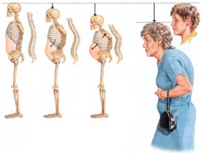 osteoporoz-pozvonochnika